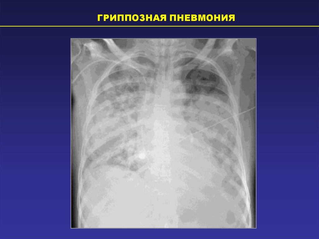 Картина пневмонии. Септическая пневмония рентген. Бактериальная пневмония рентген. Гриппозная пневмония. Септическая пневмония на рентгенограмме.