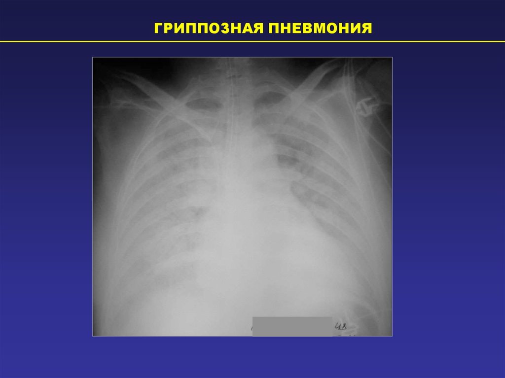 Вирусная пневмония видна на рентгене. Гриппозная пневмония. Вирусная пневмония рентген. Вирусная пневмония на рентгенограмме. Рентгенодиагностика пневмоний.