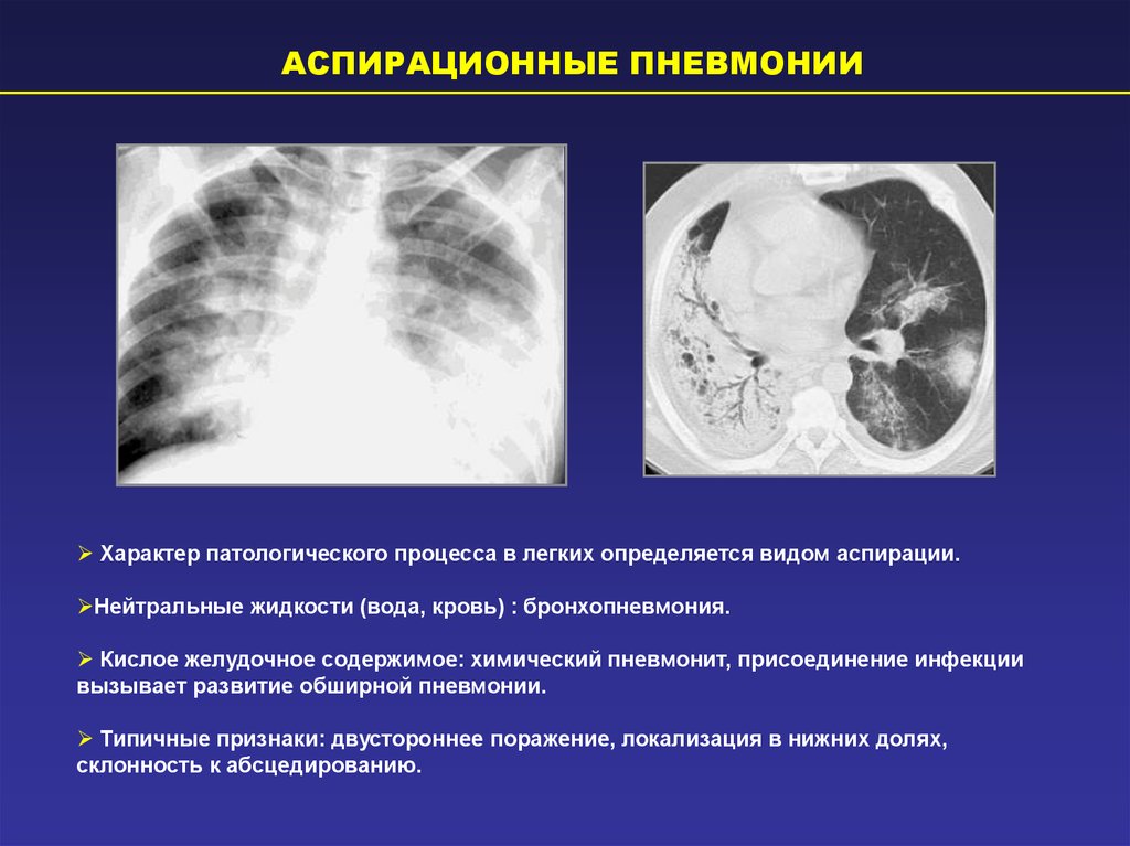 Хламидийная пневмония рентгенологическая картина - 85 фото