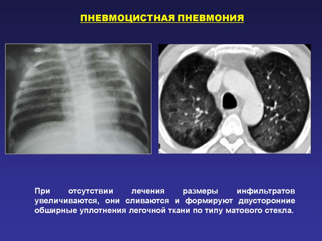 Пневмоцистная пневмония кт картина