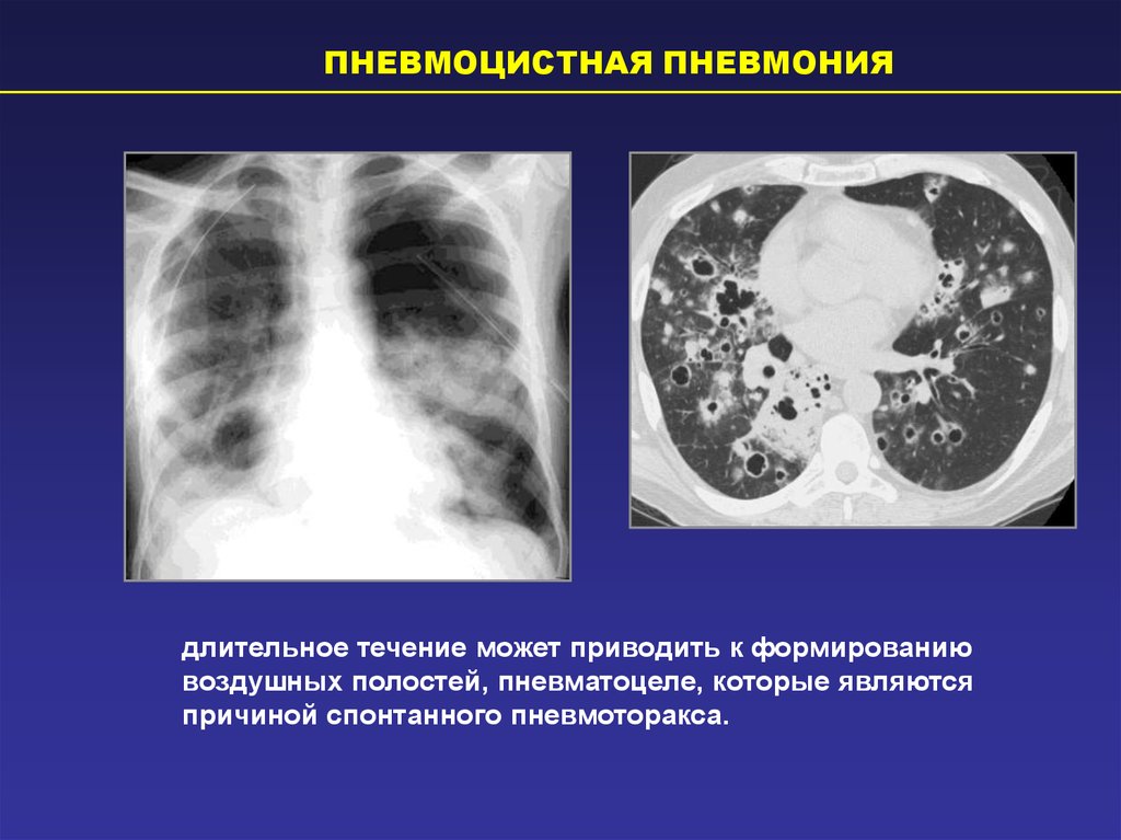 Пневмоторакс лучевая диагностика презентация