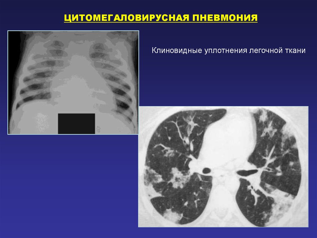 Пневмоцистная пневмония кт картина