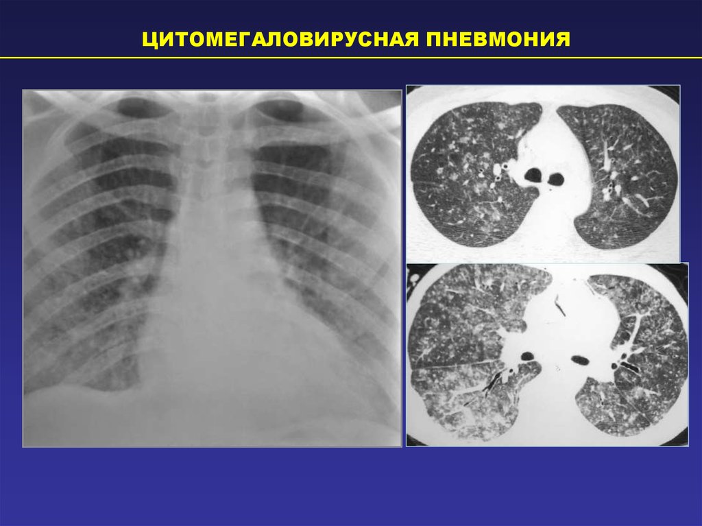 Пневмоцистная пневмония кт картина