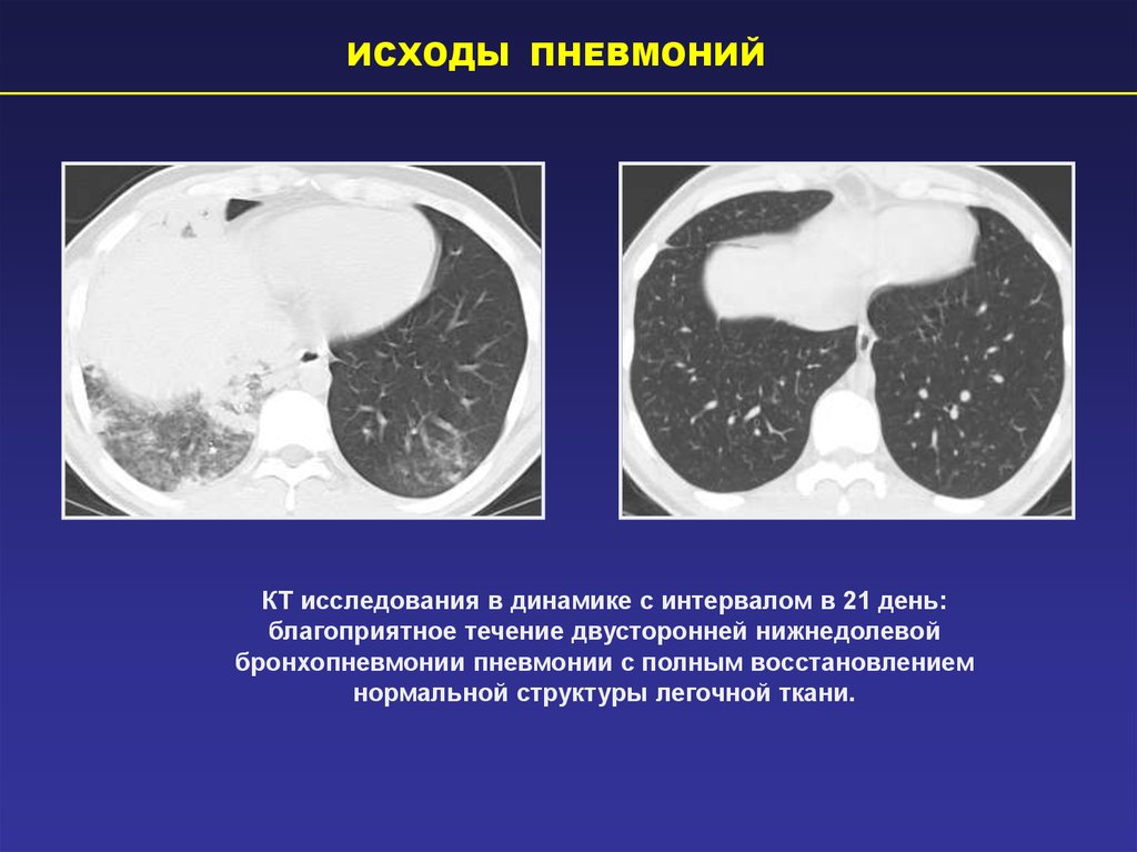 Кт легких презентация