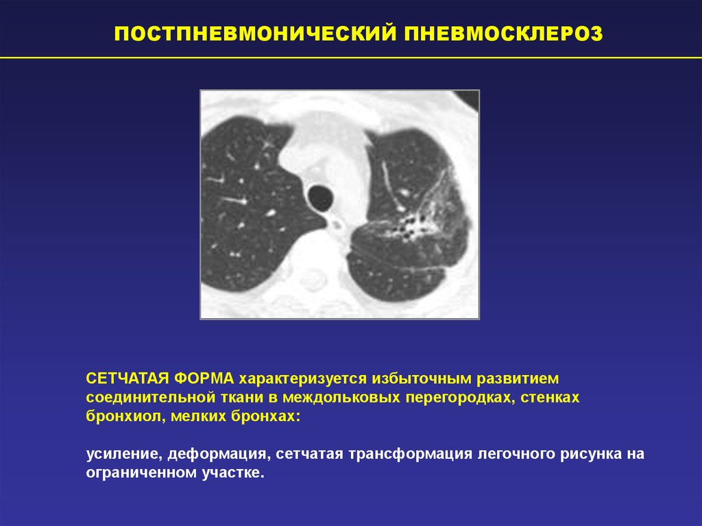 Пневмосклероз это простыми словами. Постпневмонический фиброз на кт. Пневмофиброз на кт легких. Диффузный пневмофиброз легких на кт. Локальный пневмофиброз кт.