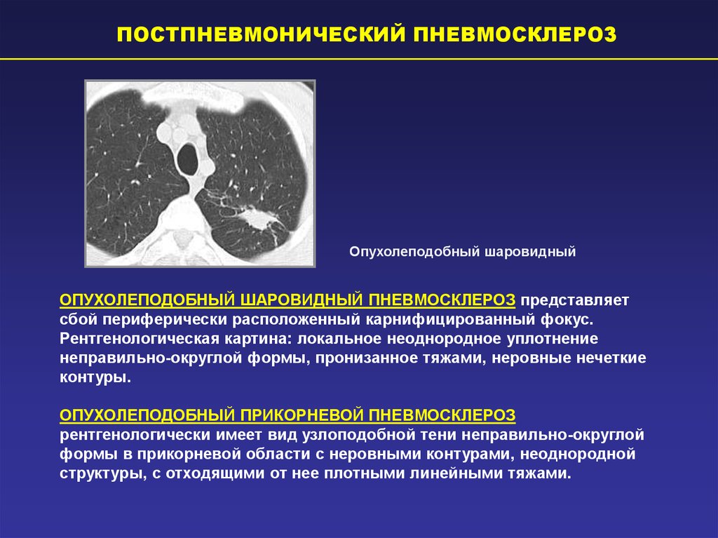 Диффузный пневмосклероз легких что это рак