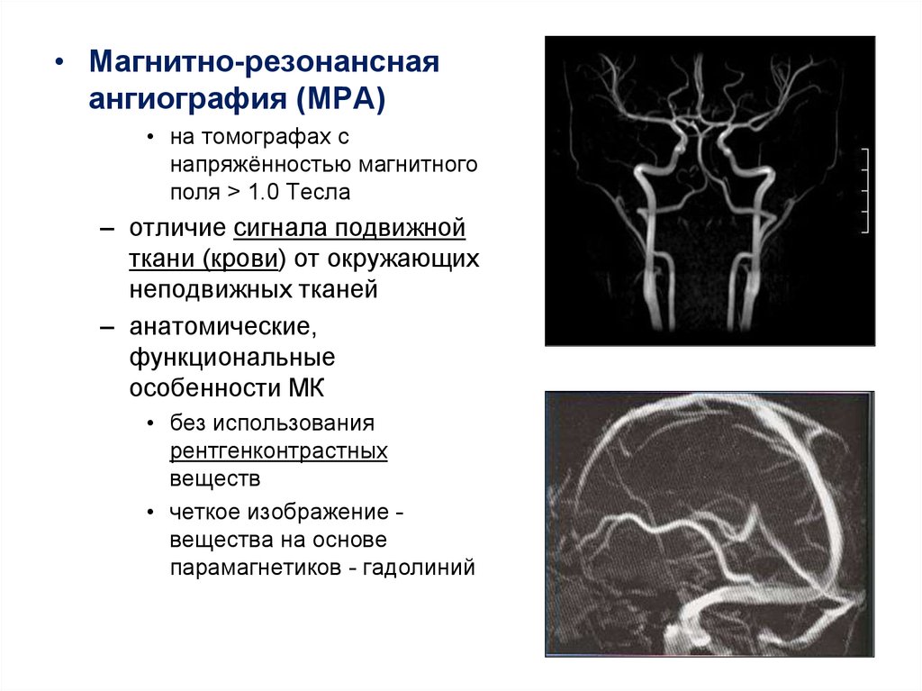 Интракраниальные артерии головного мозга. МР-ангиография сосудов головного мозга. Магнитно-резонансная ангиография сосудов головного мозга. МРА (магнитно-резонансная ангиография). Мрт ангиография интракраниальных сосудов.