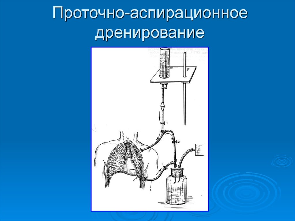 Дренирование. Аспирационное дренирование аппарат Боброва. Промывное аспирационное дренирование. Схема проточно промывного дренирования. Активная проточно аспирационное дренирование.