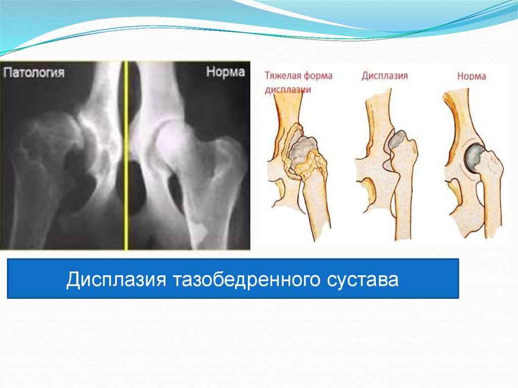 Дисплазия это. Классификация дисплазии тазобедренных суставов. Дисплазия тазобедренных суставов клиника. Дисплазия тазобедренных суставов кт. Степени дисплазии тазобедренных суставов.