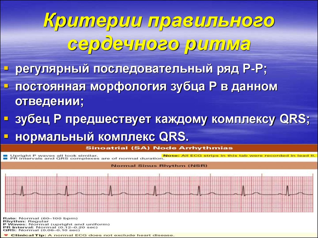 Правильный ритм. Ритм синусовая аритмия. Синусовая аритмия у ребенка. Синусовая аритмия нарушения. Нарушение сердечного ритма у детей.