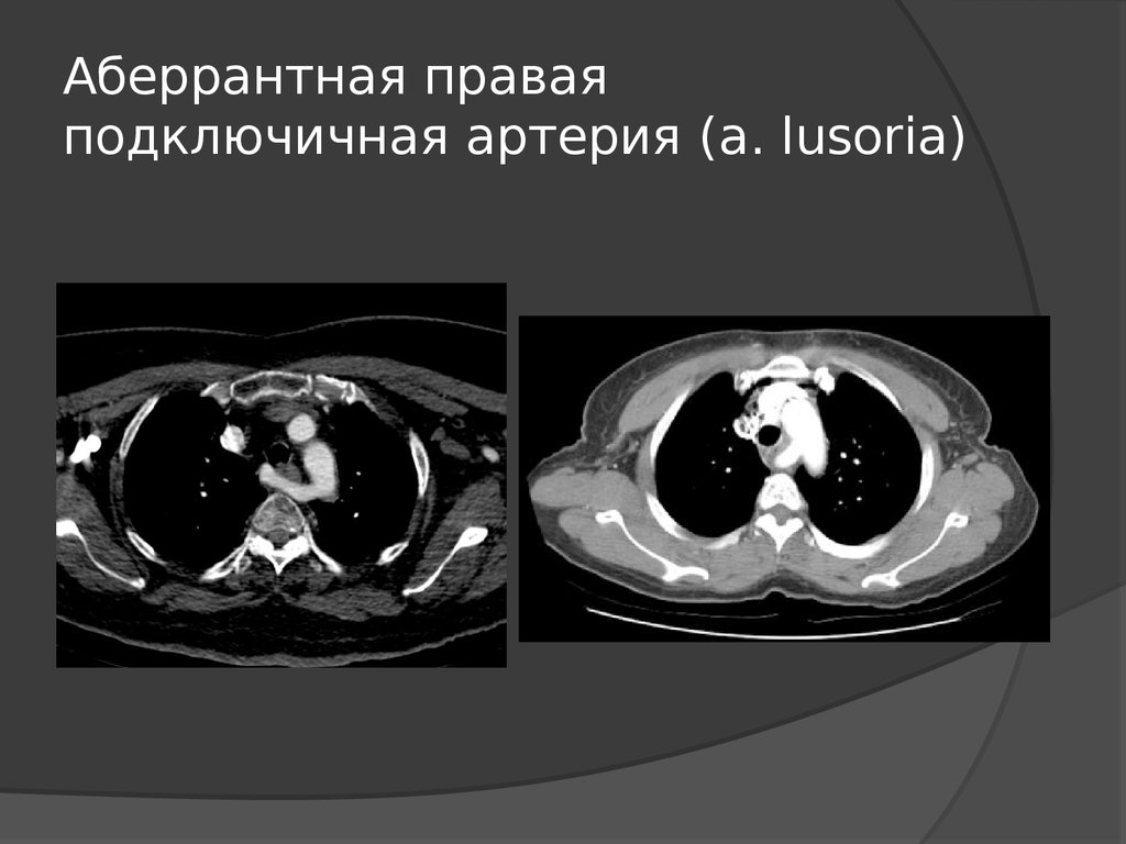 Аберрантная подключичная артерия. Аберрантная правая подключичная артерия (a. lusoria). Аберрантная подключичная артерия кт. Аберрантная левая подключичная артерия.