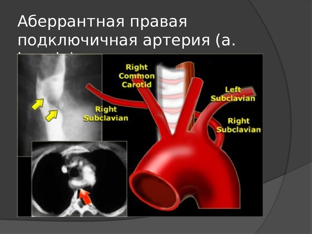 Правая аберрантная артерия. Аномалия отхождения правой подключичной артерии. Подключичная артерия, (а. subclavia),. Аббкрантная правая подключичная артерия. Аберрантная правая подключичная артерия.
