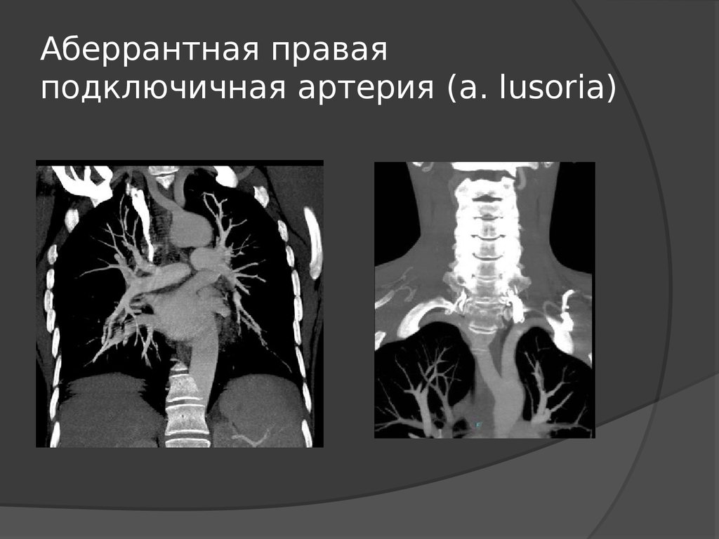 Правая аберрантная артерия. Аберрантная подключичная артерия кт. Аберрантная правая подключичная артерия. Аберрантная правая подключичная артерия (a. lusoria). Аберрантная левая подключичная артерия на кт.