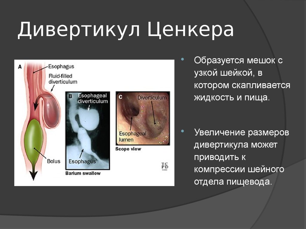 Дивертикул пищевода ценкера