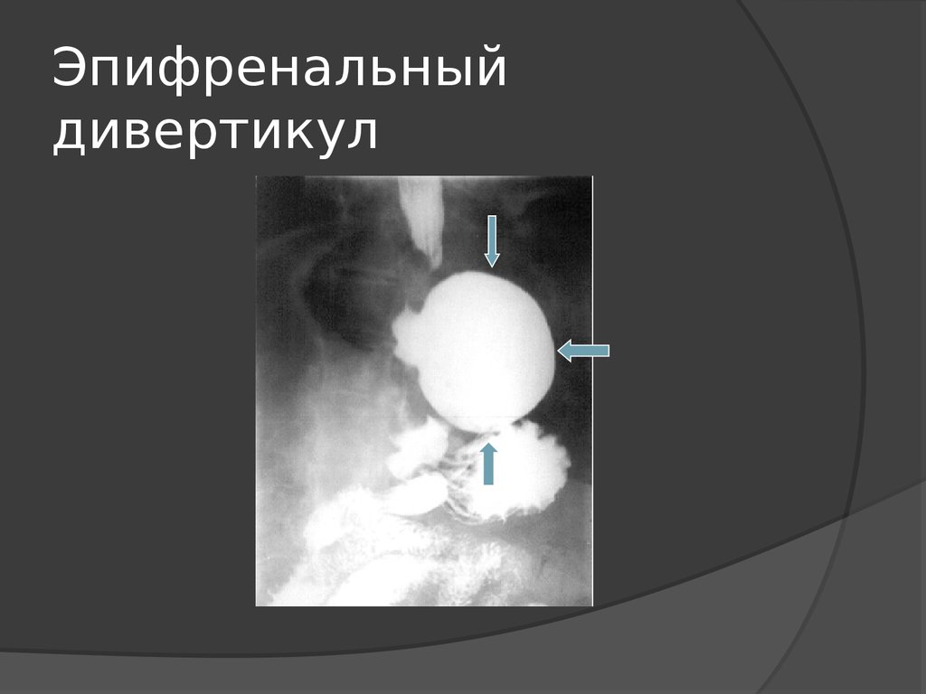 Диагностика дивертикула пищевода