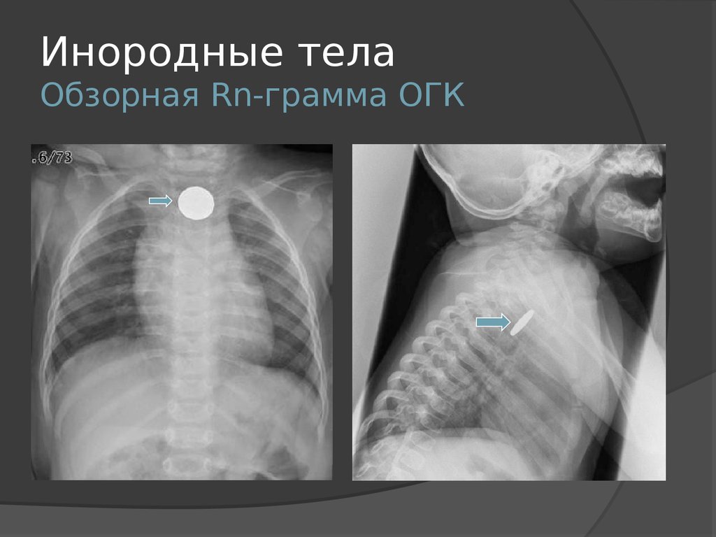 Инородные тела пищевода презентация