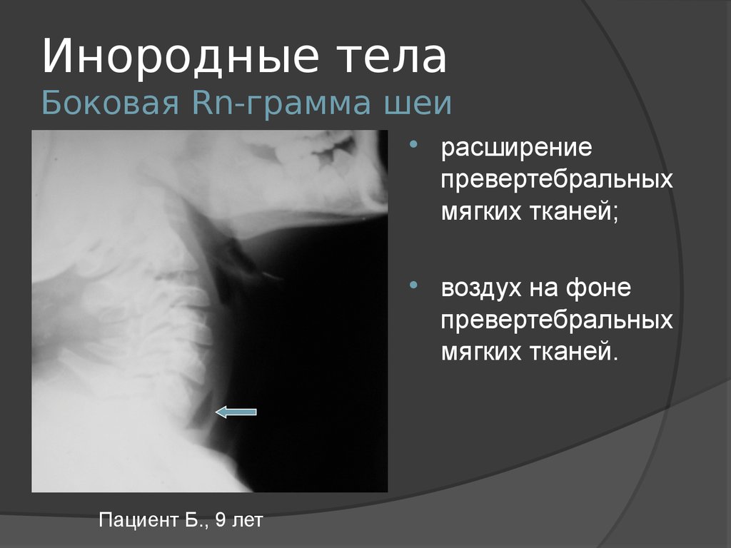 Воздух в пищеводе. Инородные тела пищевода. Инородное тело мягких тканей. Инородное тело в мягких тканях на рентгене. Инородные тела пищевода рентгенограммы.