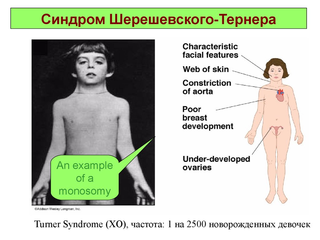 45 хромосом. Синдром Шерешевского Тернера цитогенетический метод. Тип наследования Шерешевского Тернера. Синдром Тернера-Шершевского (Хо). Болезнь Шерешевского Тернера.