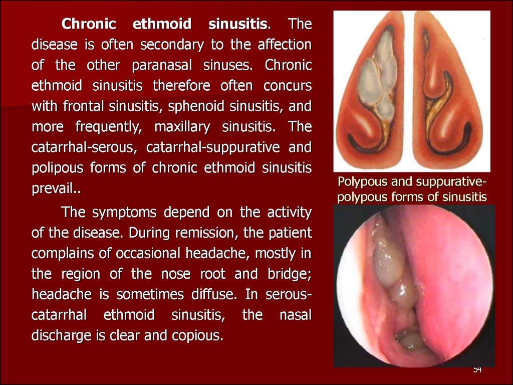 Polypous and suppurative-polypous forms of sinusitis
