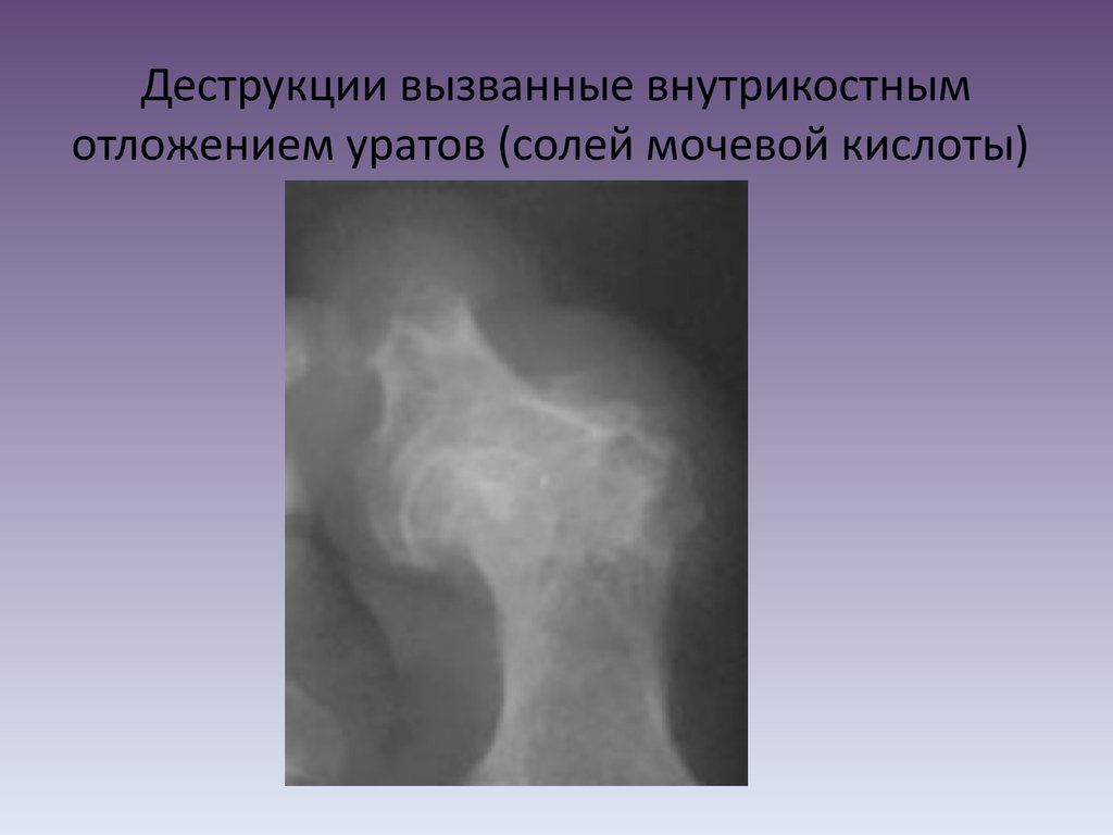 Рентген картина при подагре