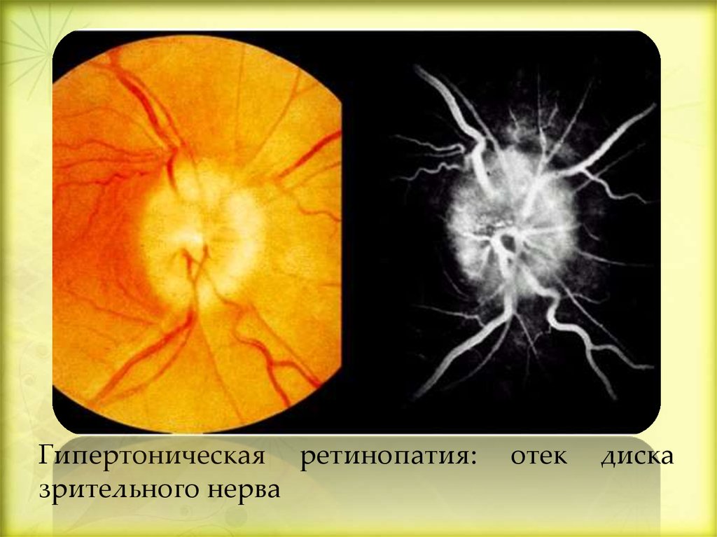 Диск зрительного нерва. Глазное дно гипертоническая ретинопатия. Отечный диск зрительного нерва. Отек диска зрительного нерва офтальмоскопия.