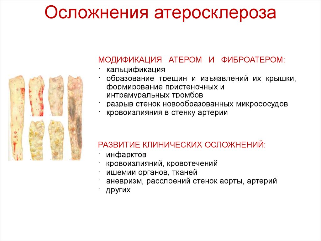 Атеросклероз аорты головного мозга. Осложнения атеросклероза. Атеросклероз последствия и осложнения. Наиболее частые осложнения атеросклероза. Аортосклерозаосложнения.