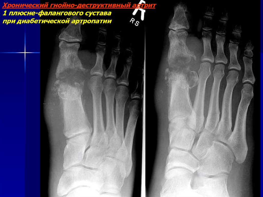 Плюсне фаланговые суставы. Остеоартропатия Шарко. Остеоартропатия Шарко рентген. Диабетическая остеоартропатия (стопа Шарко). Нейроостеоартропатия стопа Шарко.