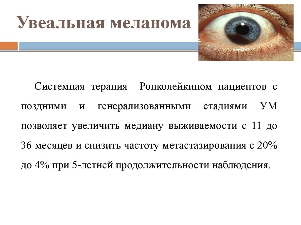 Инвалидность при меланоме. Увеальная меланома глаза. Локализация меланомы глаза. Меланома глаза меланома.