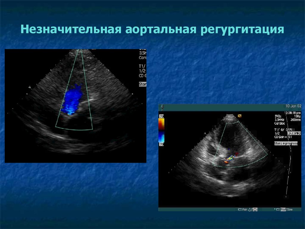 Что такое митральная регургитация