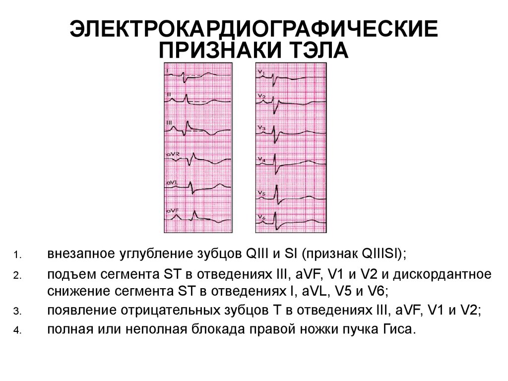 Экг при тэла картинки