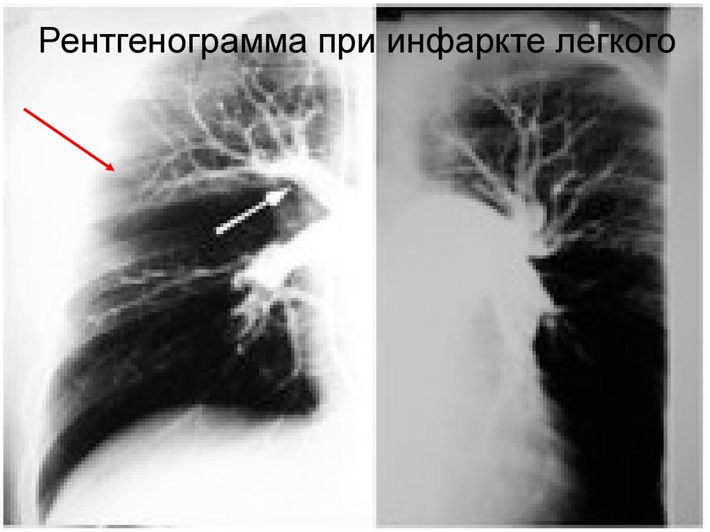 Рентгенограмма при инфаркте легкого