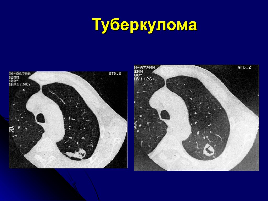 Туберкулома. Туберкулома стадии кт. Кт признаки туберкуломы. Туберкулома на кт. Туберкулома с распадом на кт.