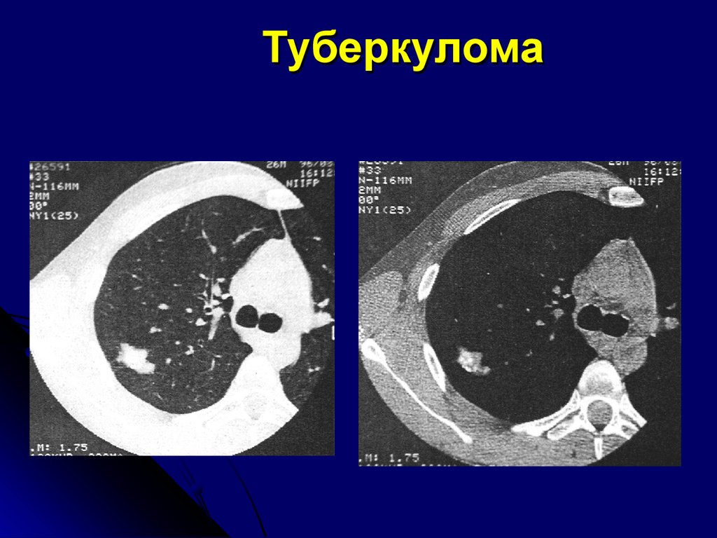 Туберкулома. Кальцинированная туберкулома. Туберкулема лёгкого кт. Туберкулома легкого на кт. Туберкулема кт картина.