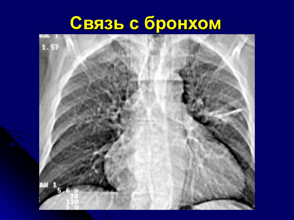 Образование в легких. Шаровидное образование в легком на кт. Шаровидные образования в легких рентген. Наименьшее образование в легких.