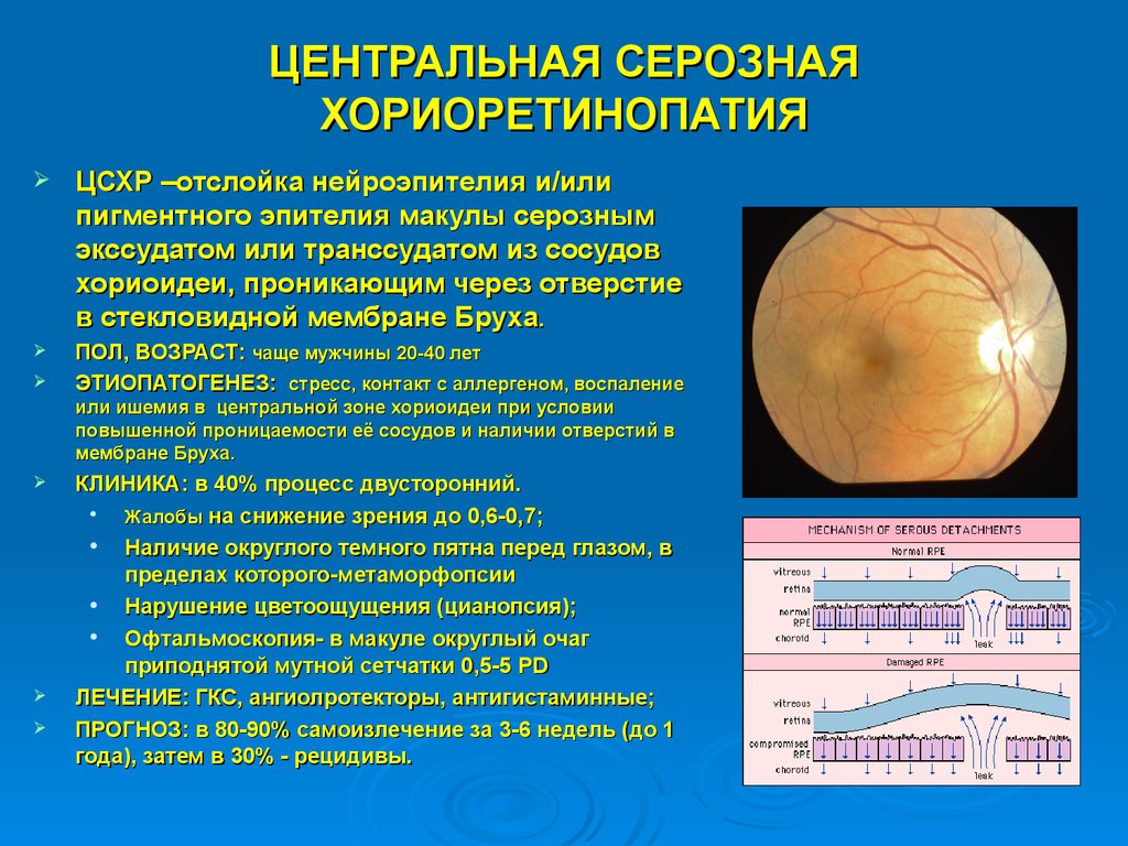 Отслойка сетчатки причины. Серозная отслойка нейроэпителия. Центральная серозная ретинопатия. Центральная серозная ретинопатия глаза. Отслойка нейроэпителия сетчатки на окт.