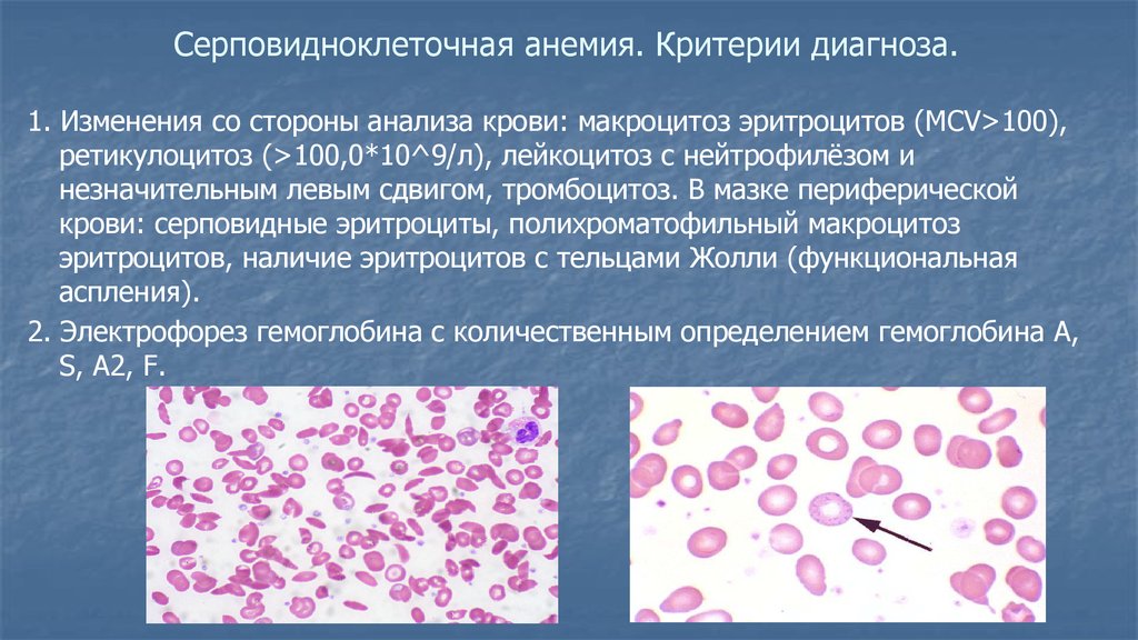 Серповидноклеточная анемия картина крови