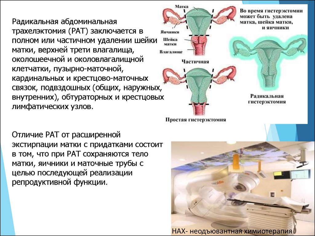 Удалила придатков матки. Ампутация и экстирпация матки. Экстрафасциальная экстирпация матки.