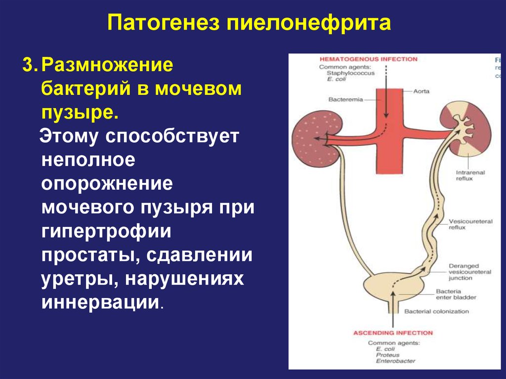 Неполное опорожнение мочевого у мужчины. Патогенез острого пиелонефрита схема. Ощущение неполного опорожнения мочевого пузыря. Механизм развития пиелонефрита. Схема патогенеза пиелонефрита.