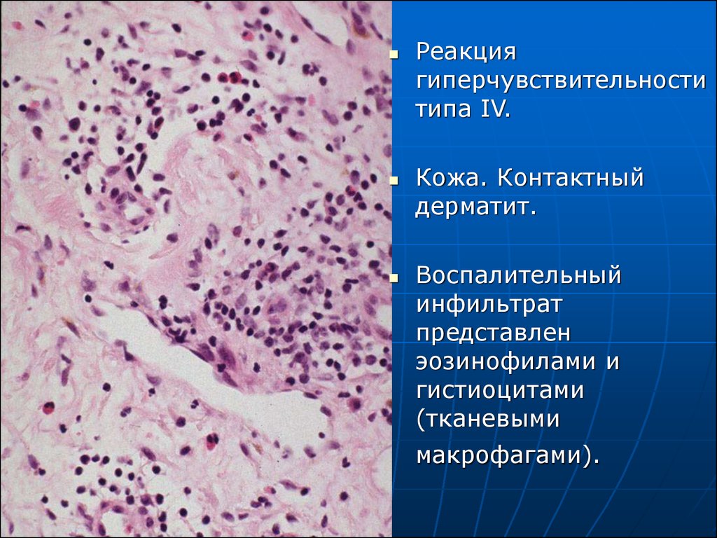 Воспалительный инфильтрат. Контактный дерматит Тип гиперчувствительности. Эозинофильный дерматит. • Гистиоциты (тканевые макрофаги). Гиперчувствительность 4 типа контактный дерматит.