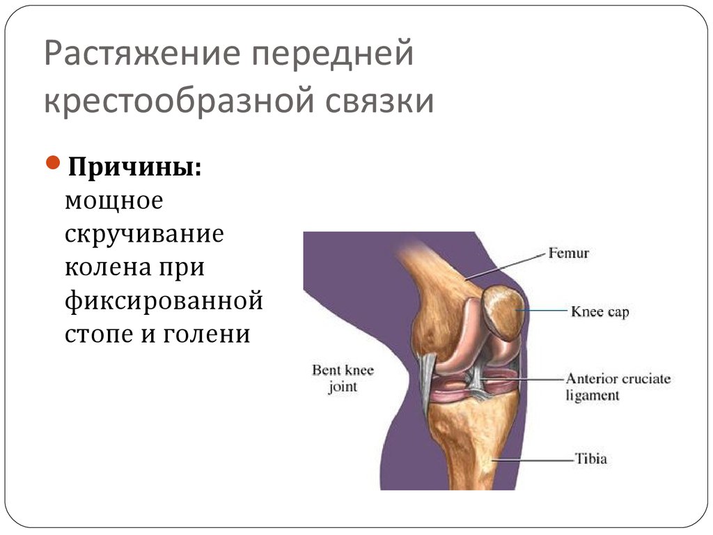 Без связки. Разрыв крестообразной связки коленного сустава анатомия. Разрыв связок коленного сустава презентация. Перерастяжение связок коленного сустава. Разрыв связок коленного сустава симптомы.