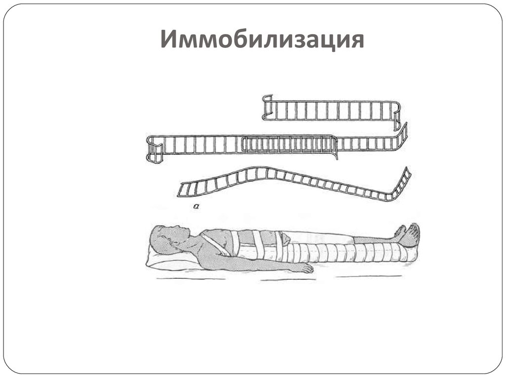 Задачи иммобилизации. Иммобилизация. Иммобилизация для слайда. Лестничные шины для иммобилизации. Коэффициент иммобилизации.