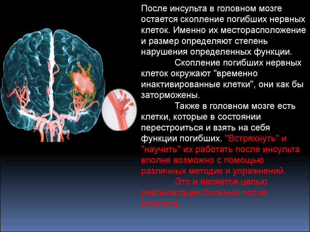 Исход инсульта. Инсульт. Головной мозг после инсульта. Головной мозг после ишемического инсульта.