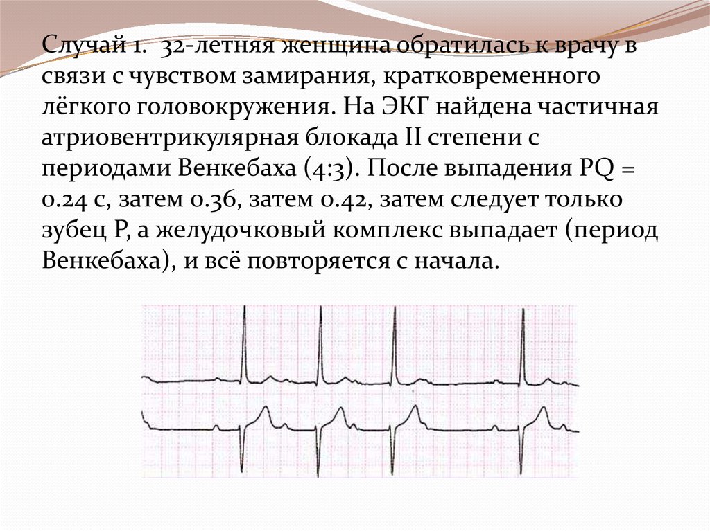 Блокада сердца. Блокады сердца на ЭКГ классификация. Период Венкебаха. Период Венкебаха на ЭКГ. Блокады сердца реферат.