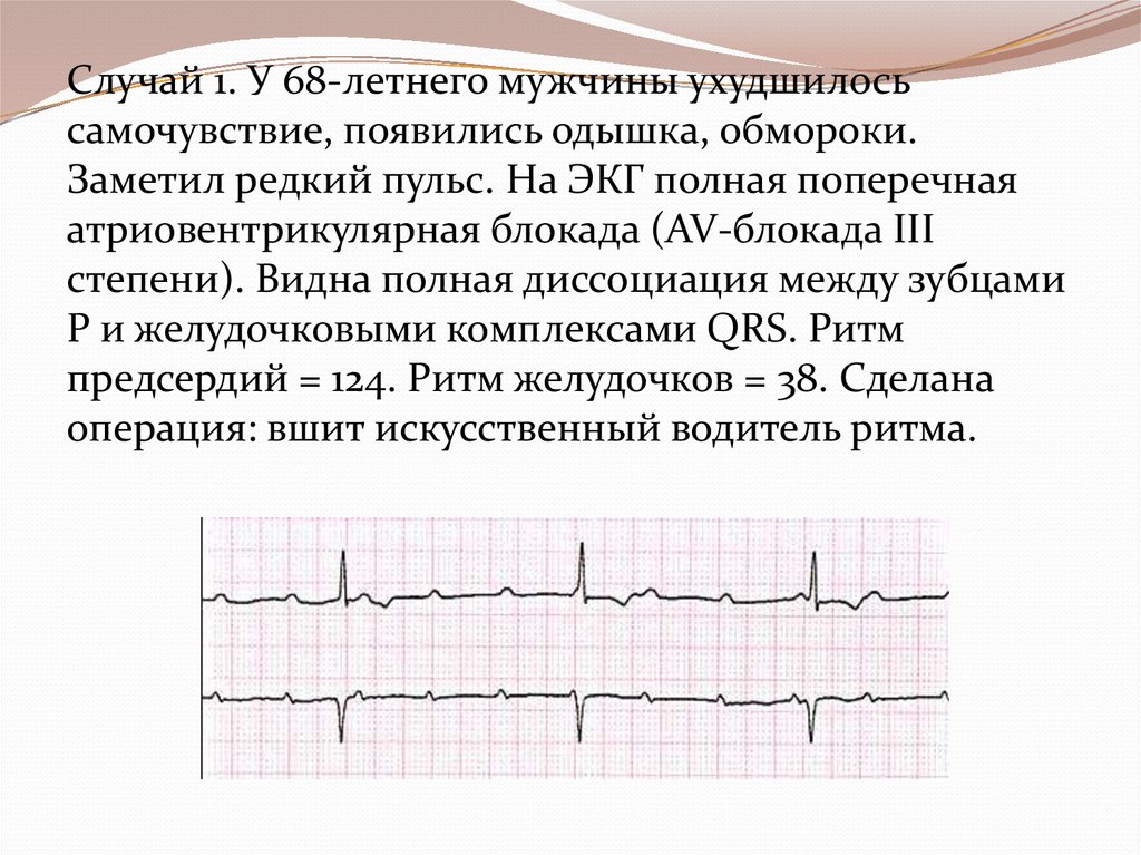 Блокада левого у сердца