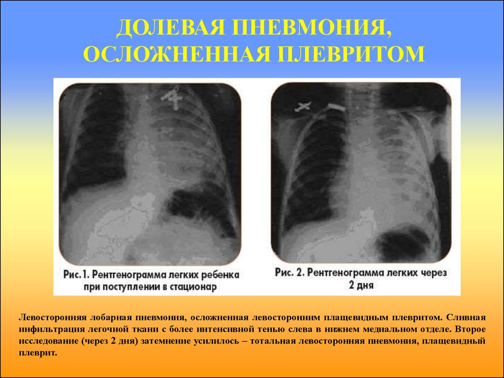 Пневмония 1. Долевая пневмония аускультативно. Плащевидный плеврит на рентгенограмме. Рентген при долевой пневмонии. Долевая пневмония рентгенограмма.