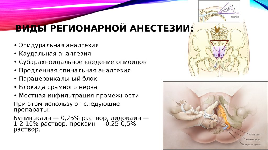 Блокада полового нерва. Пудендальная анестезия. Промежностная блокада полового нерва. Пудендальная анестезия при родах.