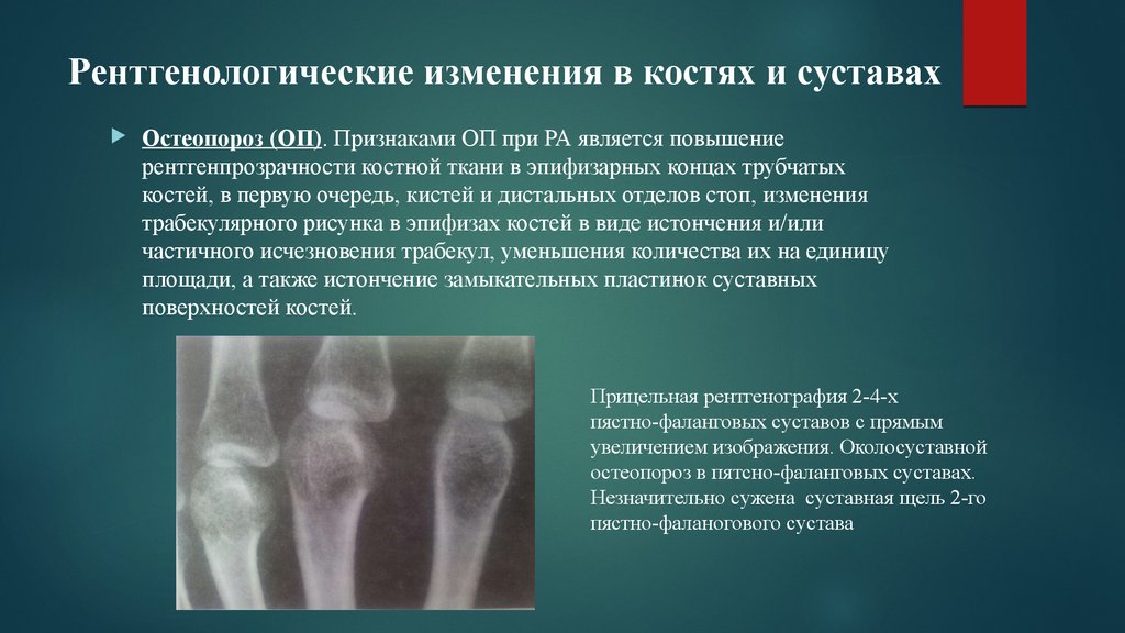 Признаком возрастных изменений костей является. Остеопороз кости рентгенологические признаки. Остеопороз рентгенологические симптомы. Остеопороз костей рентген. Рентген признаки остеопороза костей.
