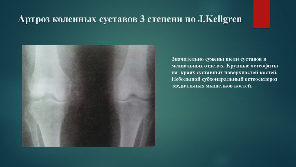 Артроз коленного сустава 3. Артроз коленного сустава рентген протокол. Деформирующий артроз коленного сустава рентген заключение. Артроз коленного сустава по Kellgren. Артроз коленного сустава 3 степени.