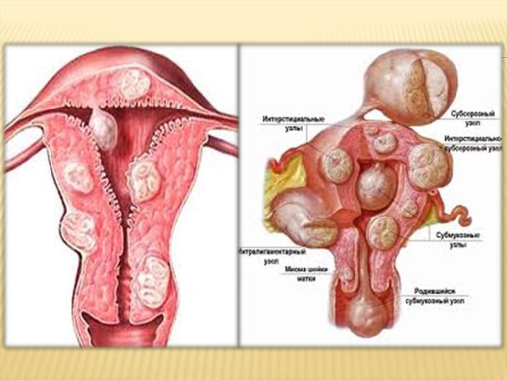 Фибромиома матки что это такое. Миома матки презентация.