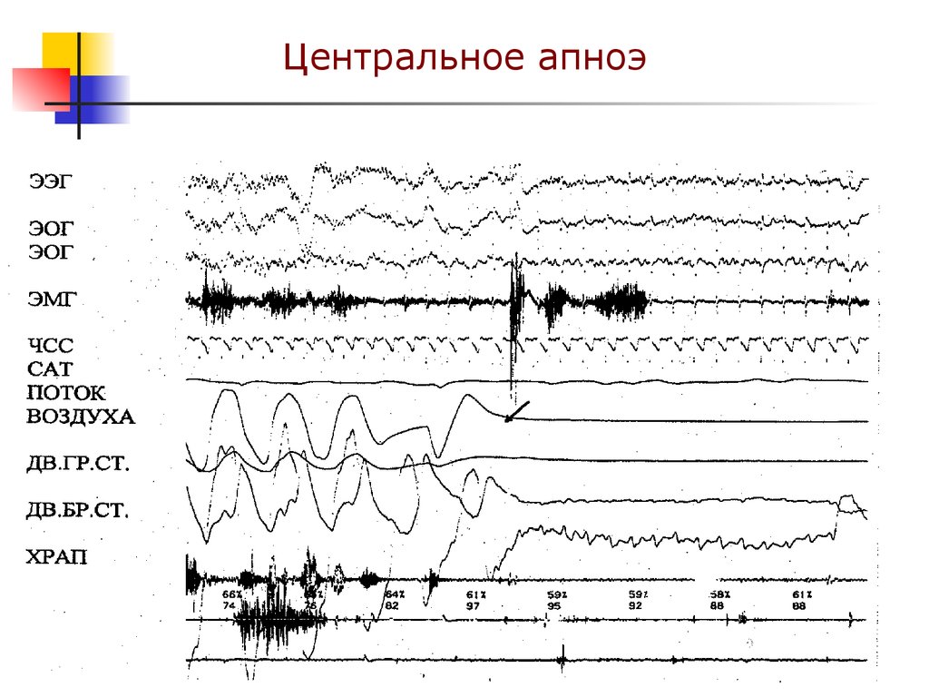 Центральное апноэ. ЭОГ. Электроокулограмма. Электроокулография (ЭОГ).